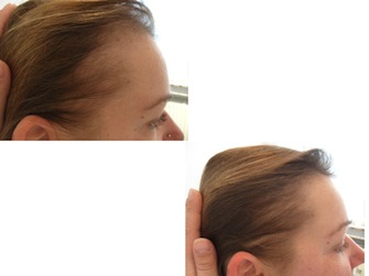 Behandlung von Alopecia areata - Beispiel 02