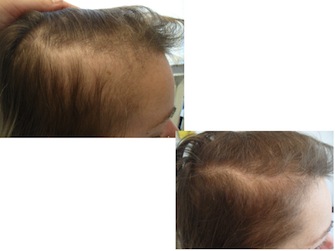 Behandlung von Alopecia areata - Beispiel 03