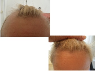 Behandlung von Alopecia areata - Beispiel 04