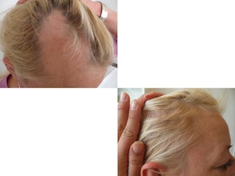 Behandlung von Alopecia areata - Beispiel 05
