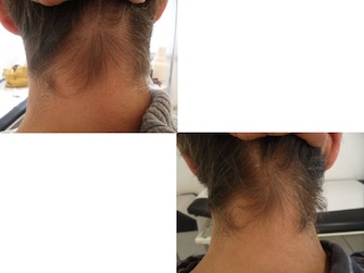 Behandlung von Alopecia areata - Beispiel 07