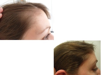 Behandlung von Alopecia areata - Beispiel 10