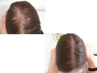 Behandlung von Alopecia areata - Beispiel 12