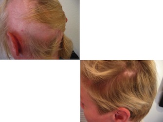 Behandlung von Alopecia areata - Beispiel 14