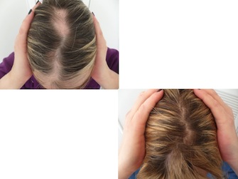 Behandlung von Alopecia areata - Beispiel 15