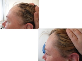 Behandlung von Alopecia areata - Beispiel 16