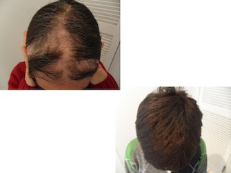 Behandlung von Alopecia areata - Beispiel 18