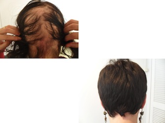 Behandlung von Alopecia areata - Beispiel 19