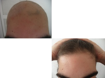 Behandlung von Alopecia areata - Beispiel 20