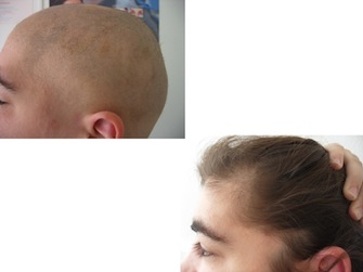 Behandlung von Alopecia areata - Beispiel 21