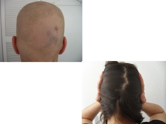 Behandlung von Alopecia areata - Beispiel 22